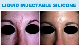 Liquid Injectable Silicone - Before & After Photos